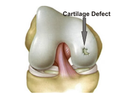 Cartilage Defect Treatment Bangalore